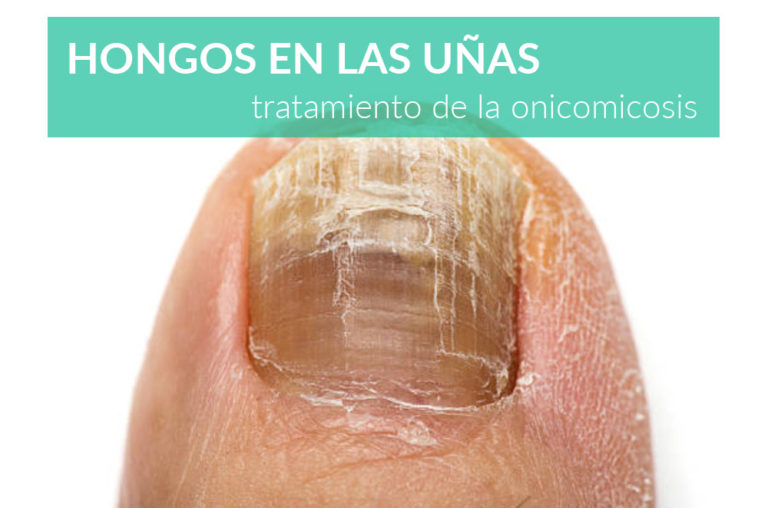 Hongos En Las Uñas Tratamiento De La Onicomicosis 5900